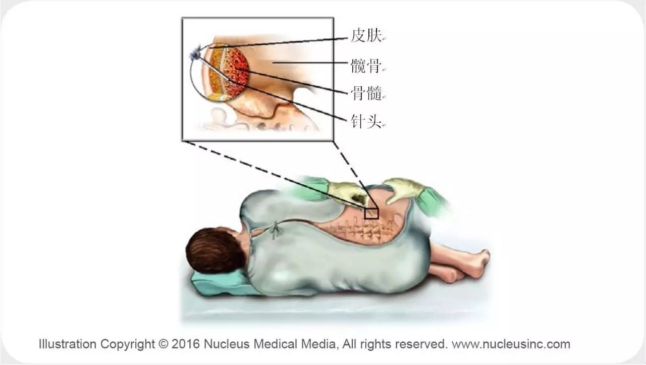 图2.2 骨穿