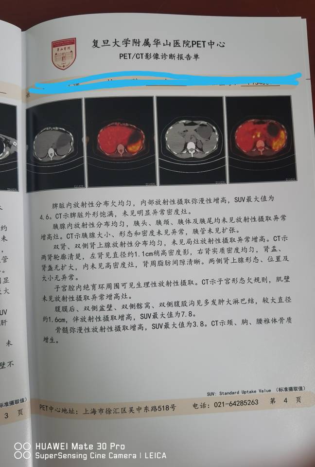 petct淋巴结suv值最高17.2,一定是淋巴瘤吗?