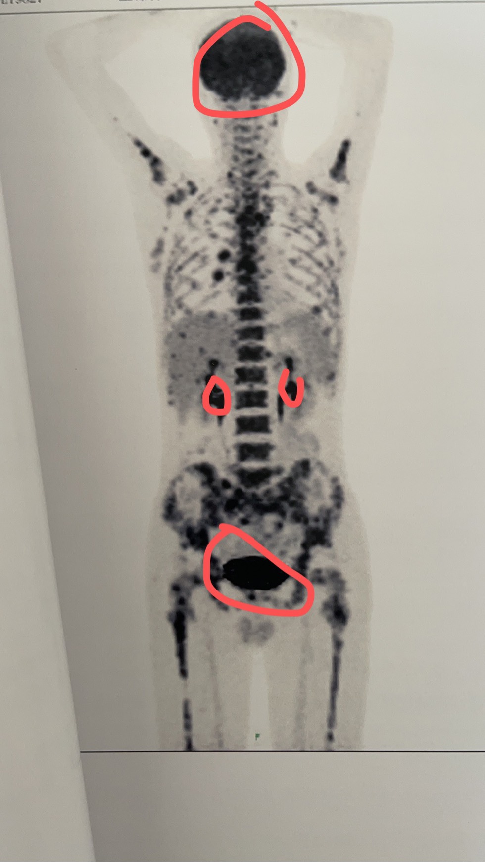 跪求有经验的看下我父亲的petct到底如何